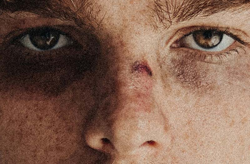 Kinder und Jugendliche als Täter von Gewalttaten: Hier ein Jugendlicher mit straken Verletzungen.